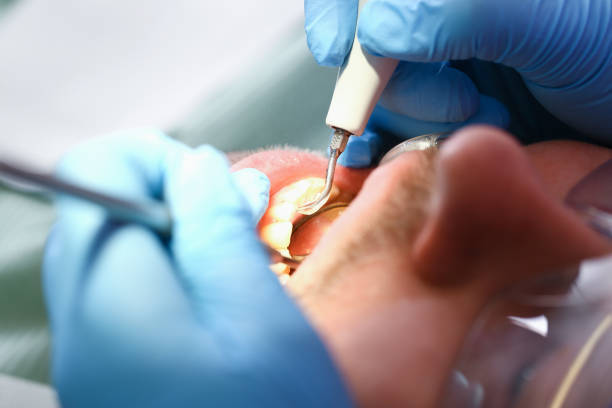 Best Emergency Wisdom Teeth Removal in Lakeview, GA