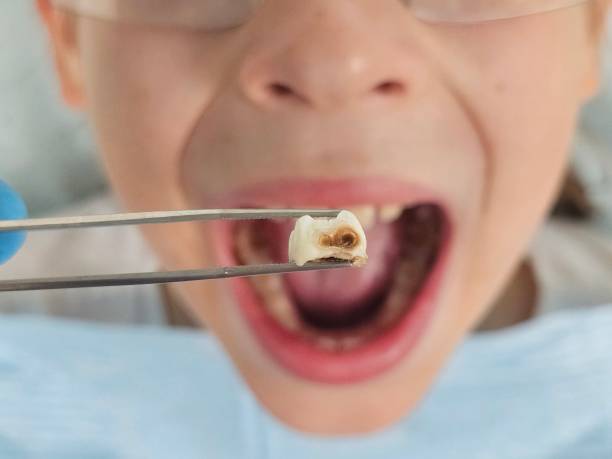 Best Emergency Broken Tooth Repair in Lakeview, GA